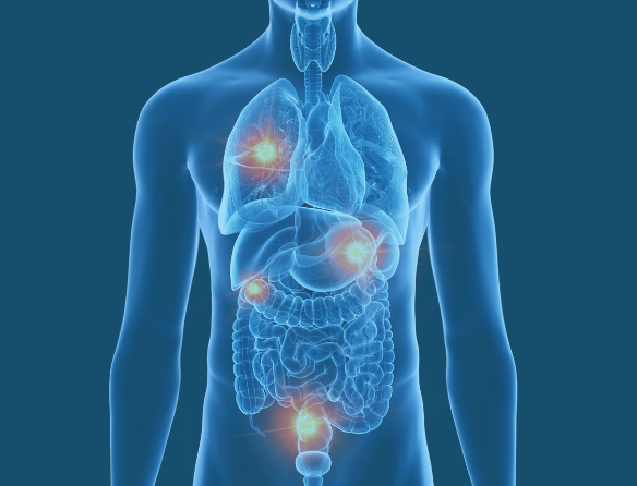 Understanding Cancer: What They Won't Tell You